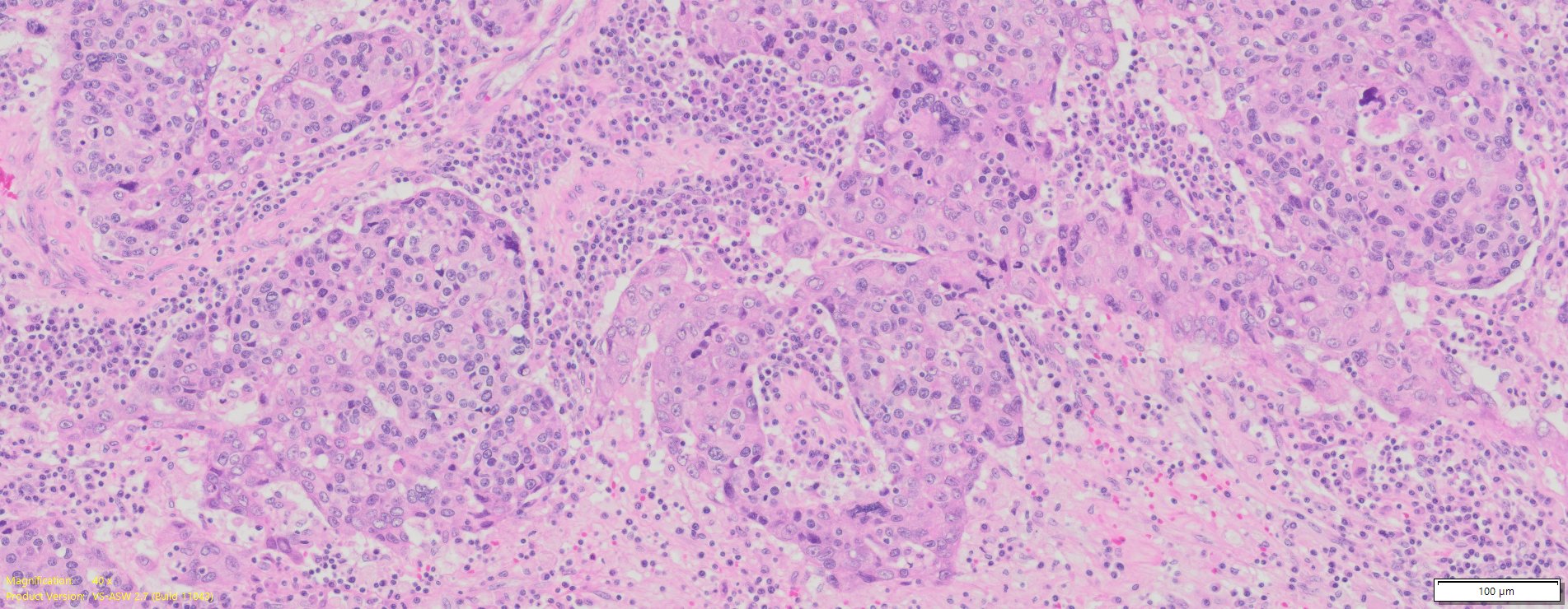 Human Ovary Cancer (Serous cyst adenocarcinoma) FFPE Sections