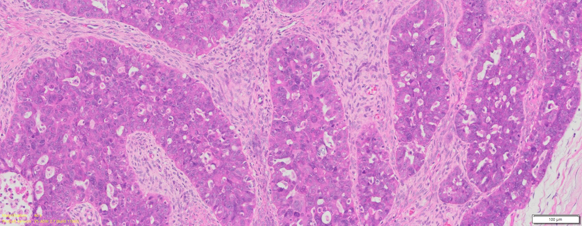 Human Ovary Cancer (Serous adenocarcinoma) FFPE Sections