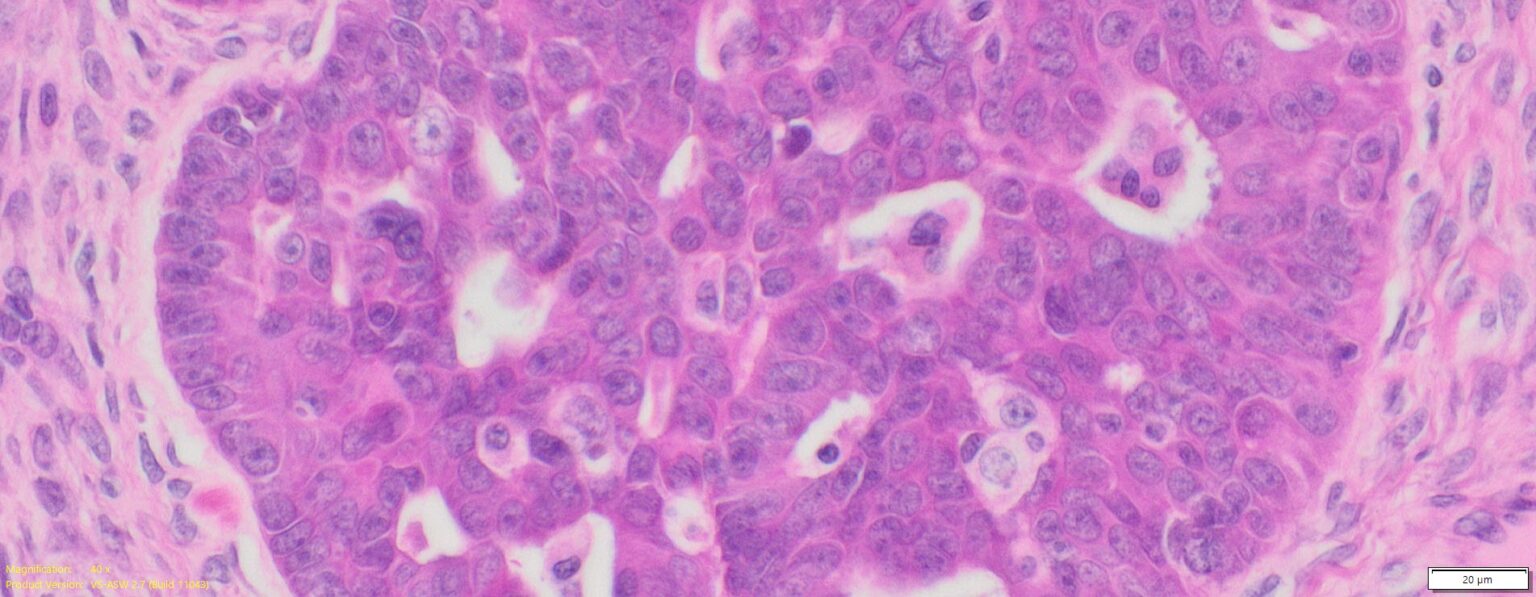 Human Ovary Cancer (Serous adenocarcinoma) FFPE Sections