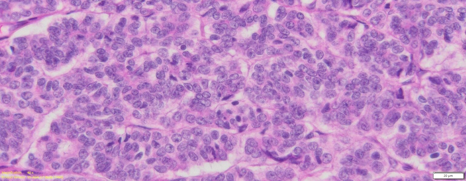 Human Ovary Cancer (Serous cyst adenocarcinoma) FFPE Sections