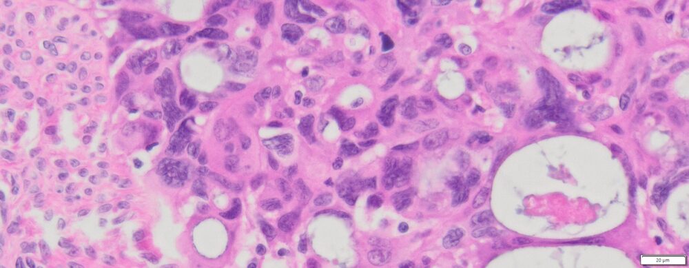Human Ovary Cancer (Serous cyst adenocarcinoma) FFPE Sections