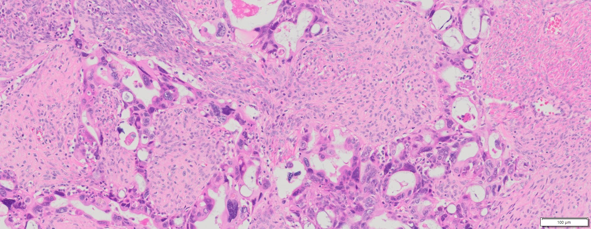 Human Ovary Cancer (Serous cyst adenocarcinoma) FFPE Sections