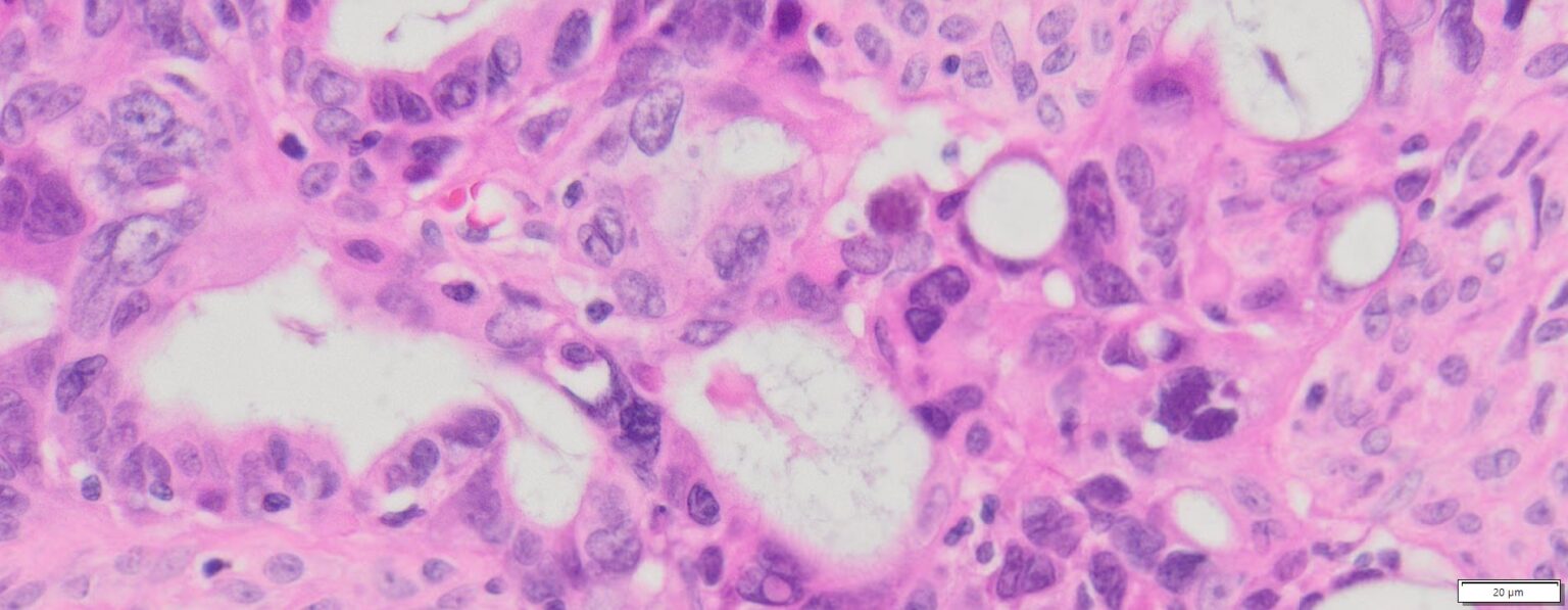 Human Ovary Cancer (Serous cyst adenocarcinoma) FFPE Sections