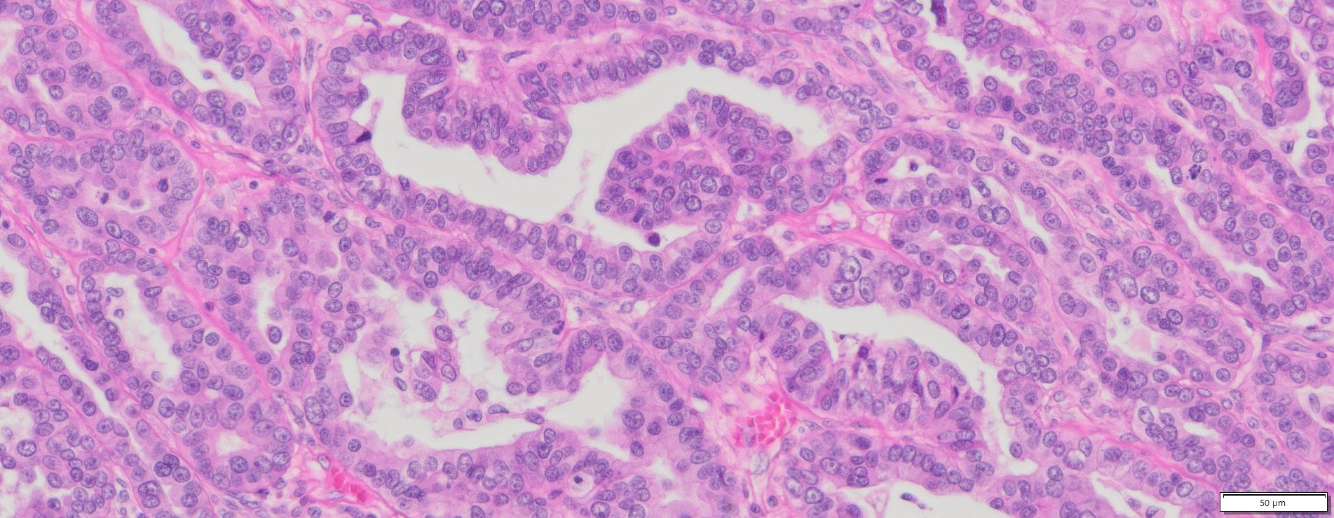 Human Ovary Cancer (Serous cyst adenocarcinoma) FFPE Sections