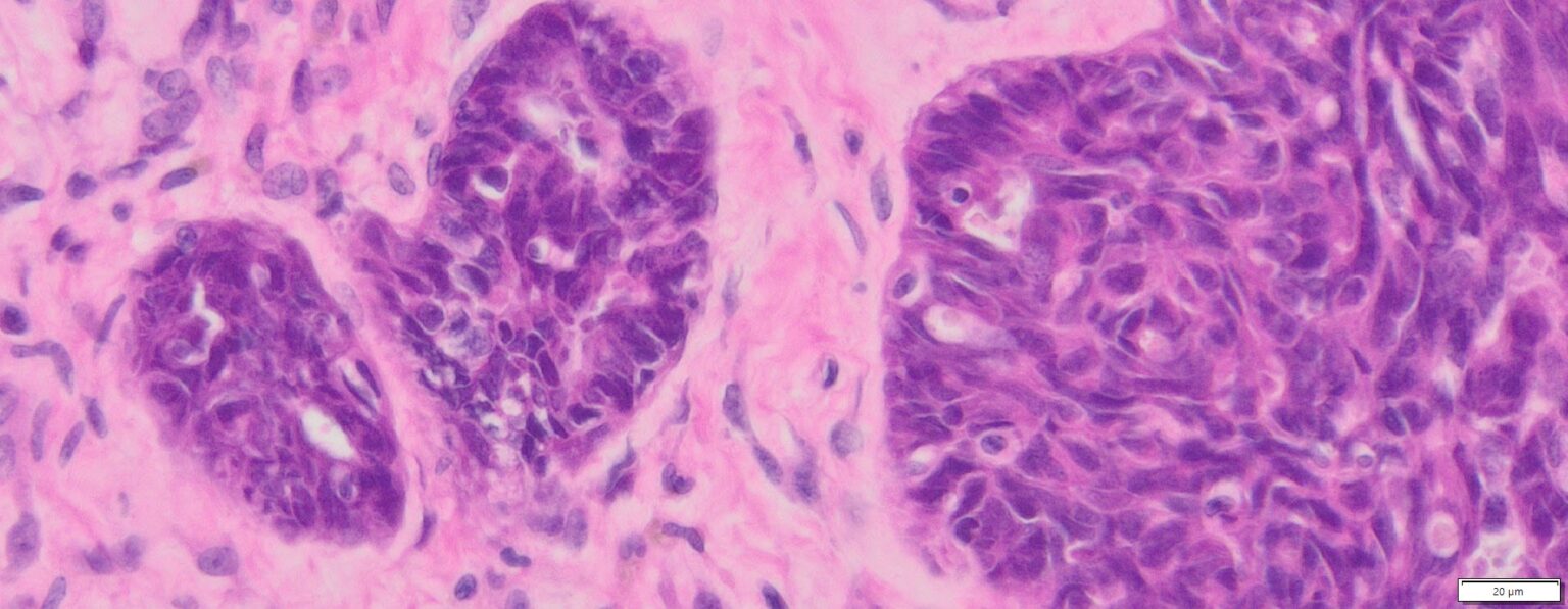 Human Ovary Cancer (Serous cyst adenocarcinoma) FFPE Sections
