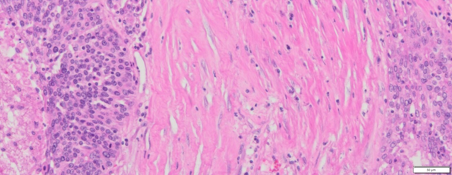 Human Ovary Cancer (Serous cyst Adenocarcinoma) FFPE Sections