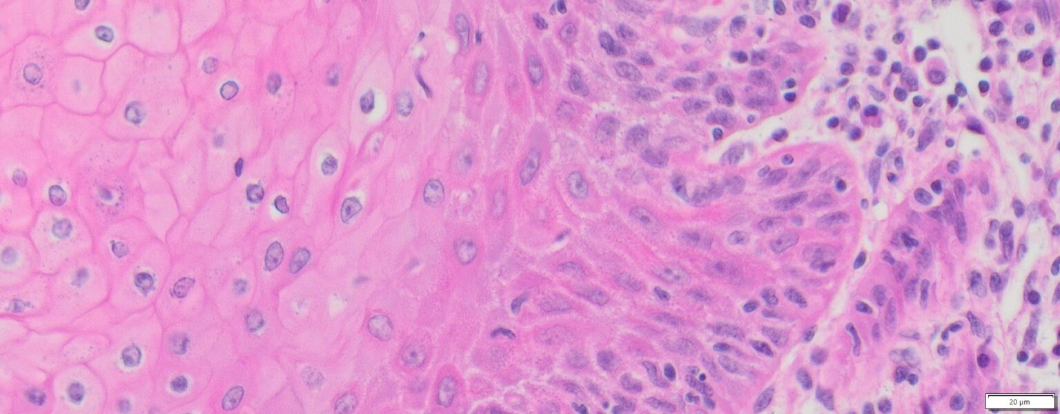 Human Endometrioid (Carcinoma with Squamous Differentiation) FFPE ...