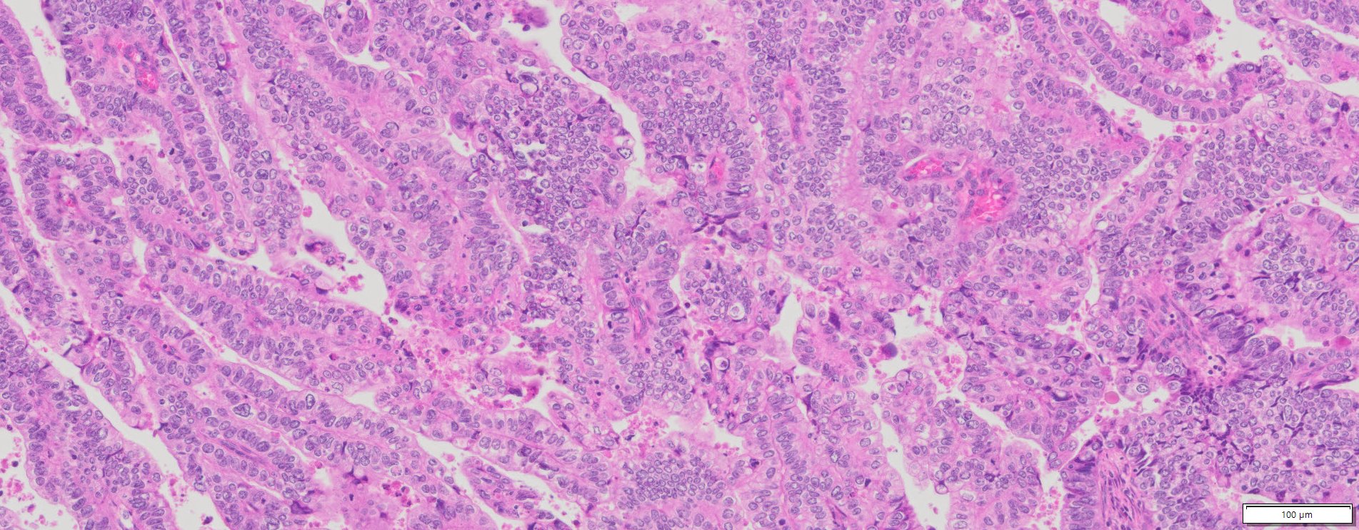 Human Endometrial Cancer FFPE Sections