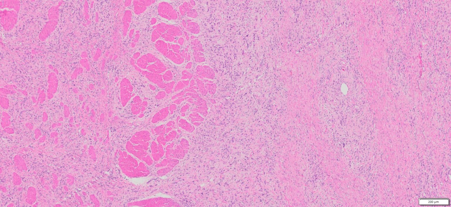 Human Gastric (Stomach adenocarcinoma) FFPE Sections