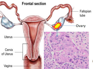 Human Ovary Cancer Sections