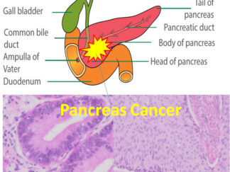 Human Pancreas Cancer Sections