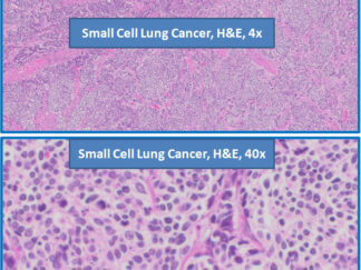 Human Small Cell Lung Cancer FFPE Sections