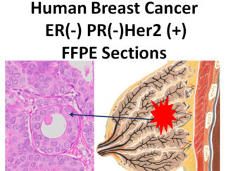 Human Breast Cancer ER-/PR-/Her2+FFPE Sections