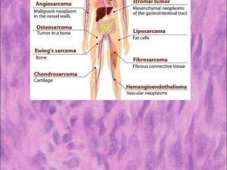 Human Sarcoma FFPE Sections
