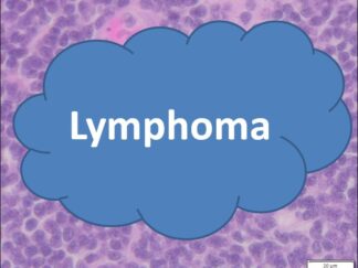 Human Lymphoma FFPE Sections