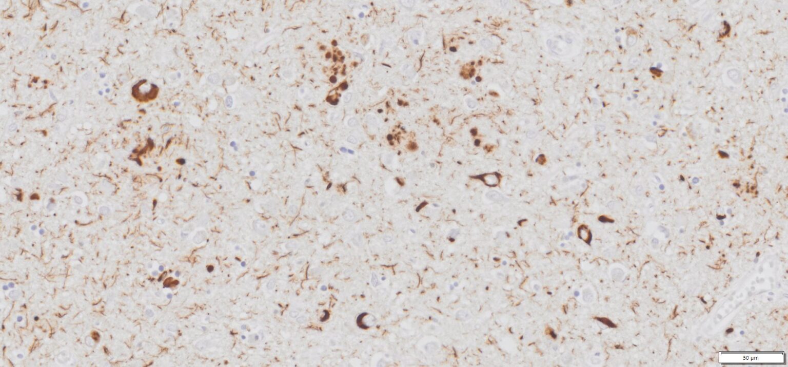 Positive Control Slides of Human Alzheimer’s Disease Brain FFPE ...