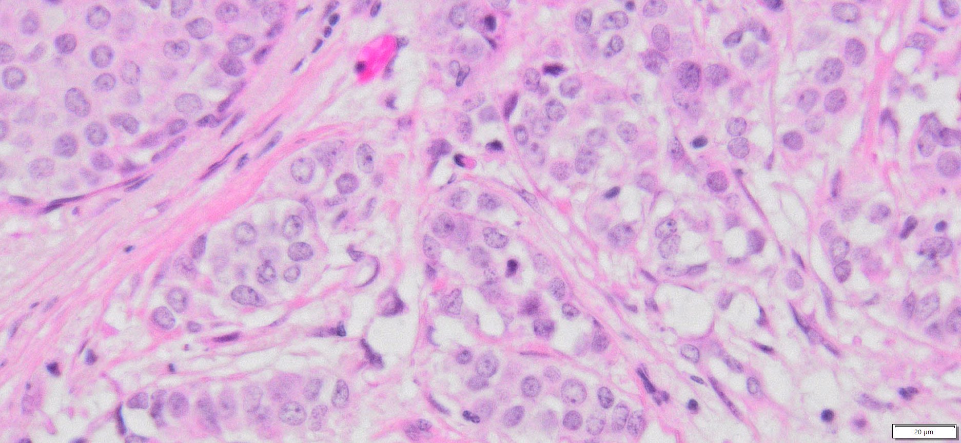 HuPS-020032T1 Breast Invasive lobular carcinoma, H&E, 40x