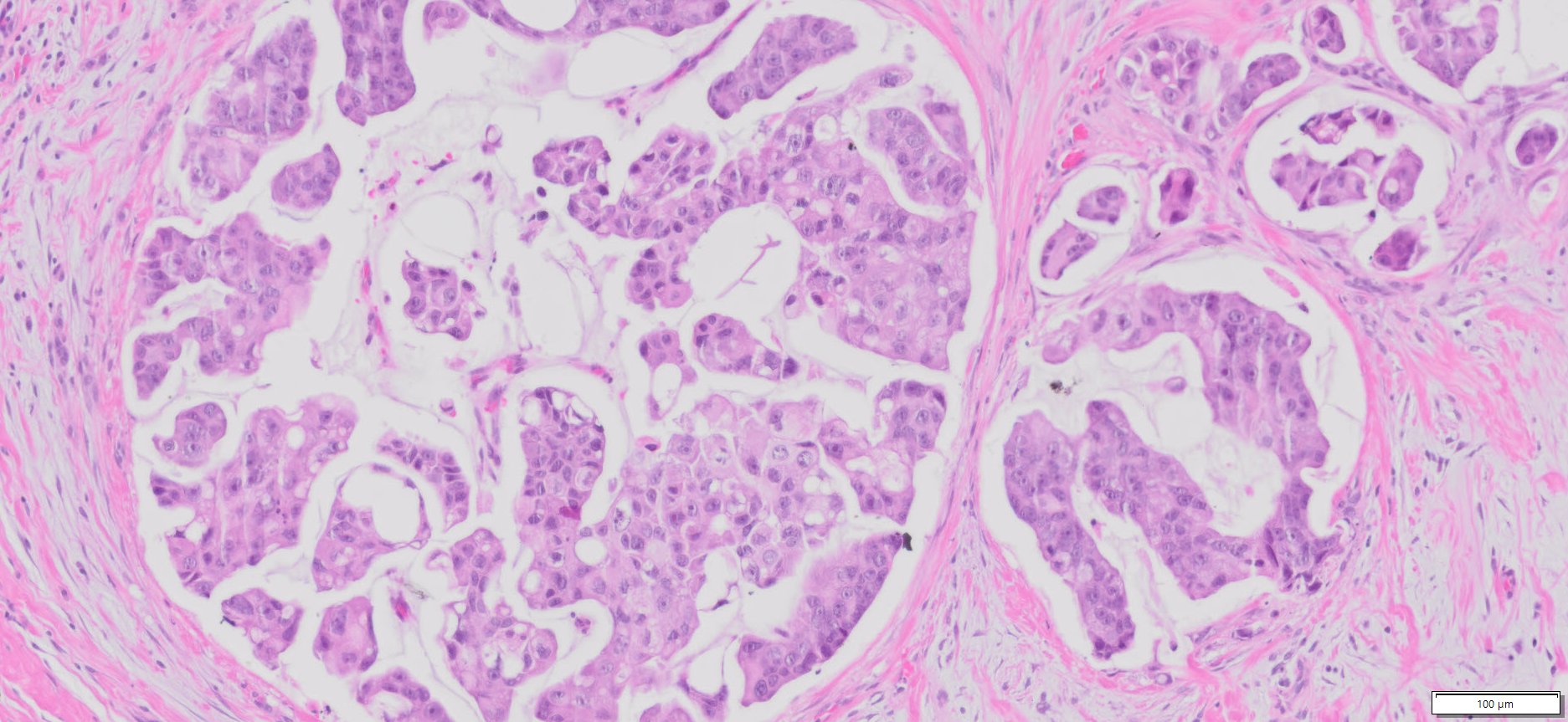 Human Breast Cancer (Invasive ductal carcinoma ) FFPE Sections