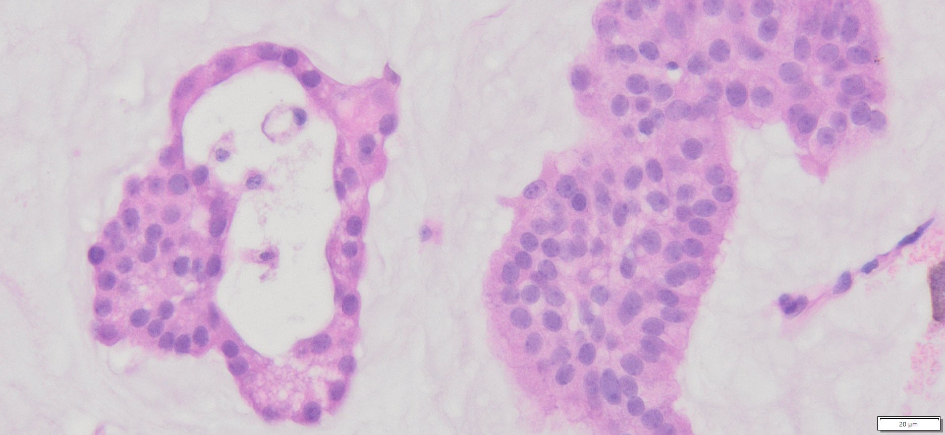 HuPS-02030T1 Breast Adenocarcinoma, H&E, 40x