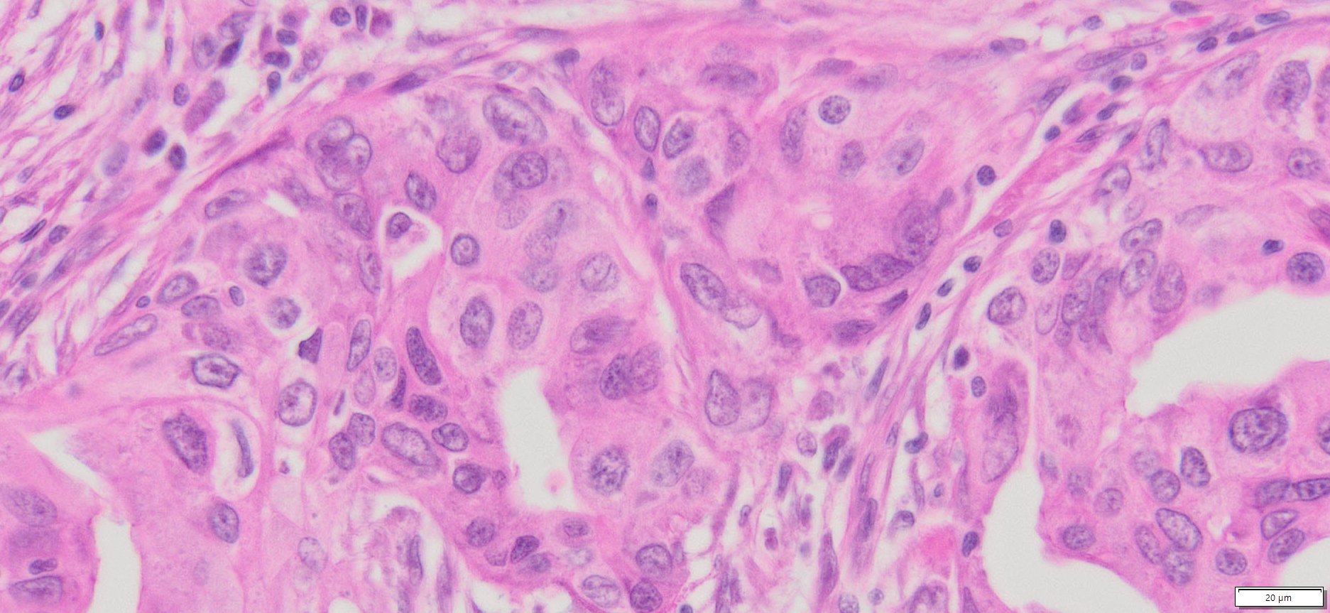 Human Breast Cancer (Invasive ductal carcinoma ) FFPE Sections