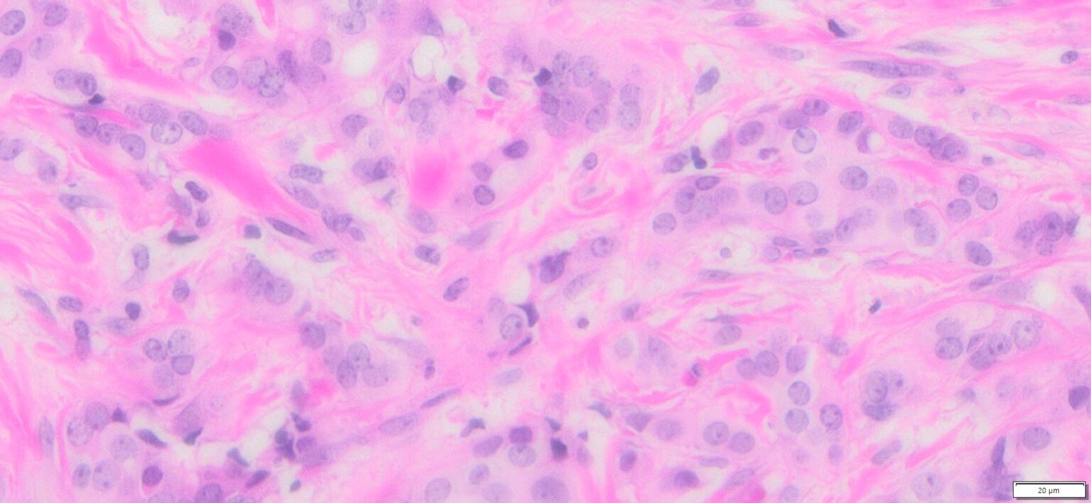 Human Breast Cancer, Triple Positive (ER+/PR+/Her2+), (Invasive ductal ...