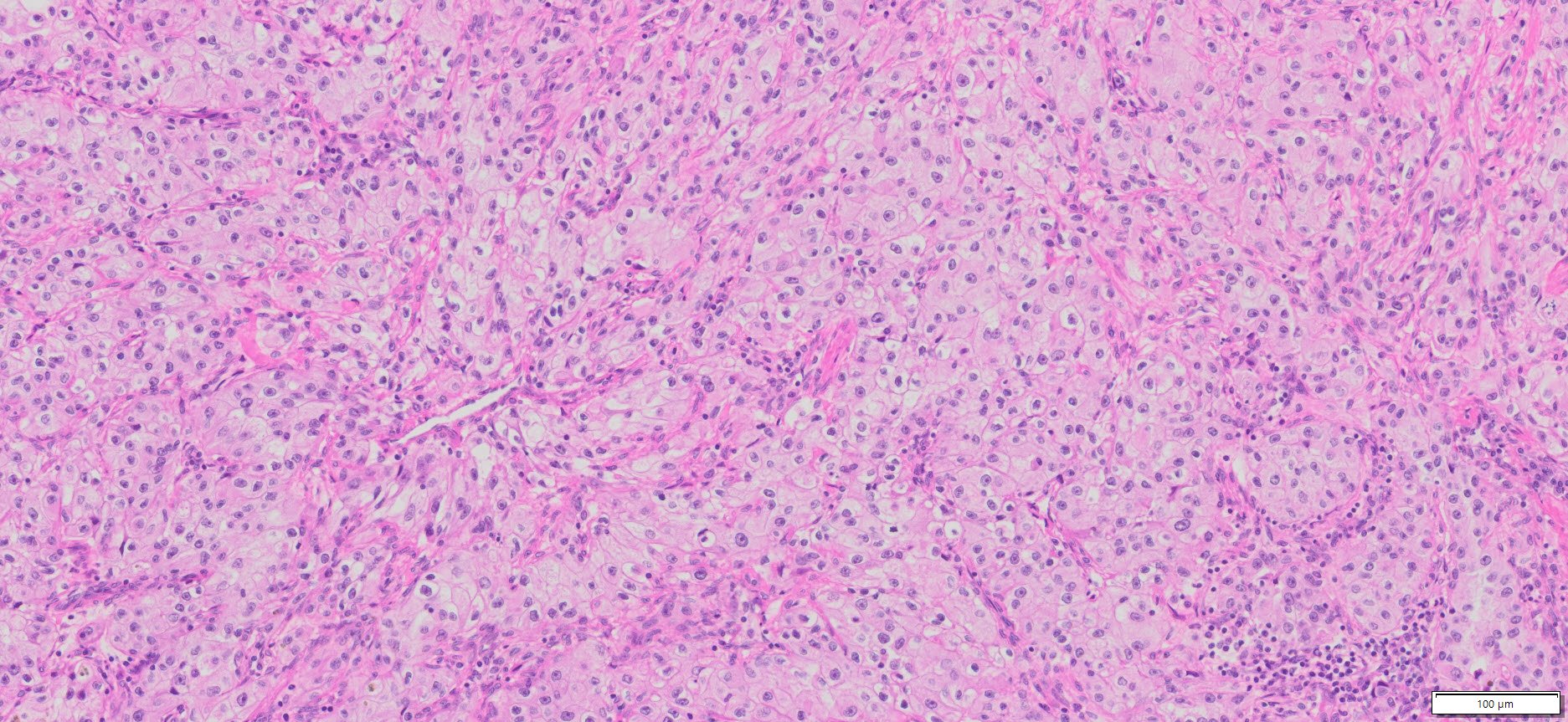 Human Clear Cell Renal Cell Carcinoma FFPE Sections