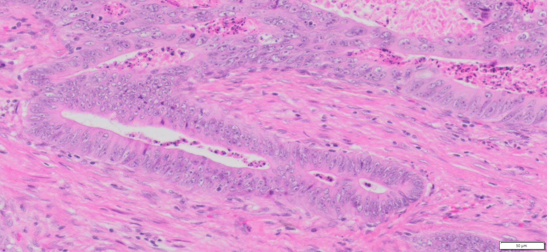 HuPS-07009T Rectum Moderately Differentiated Adenocarcinoma, H&E, 20x