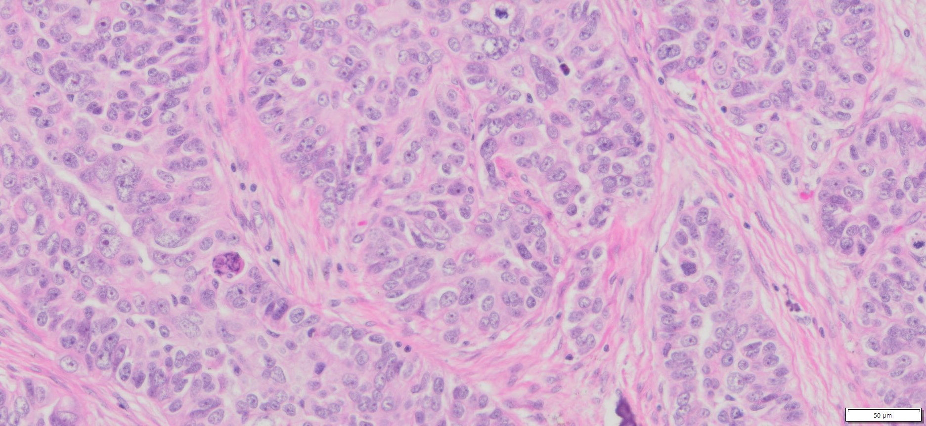 Human Ovary High Grade Serous Carcinoma (HGSC) FFPE Sections