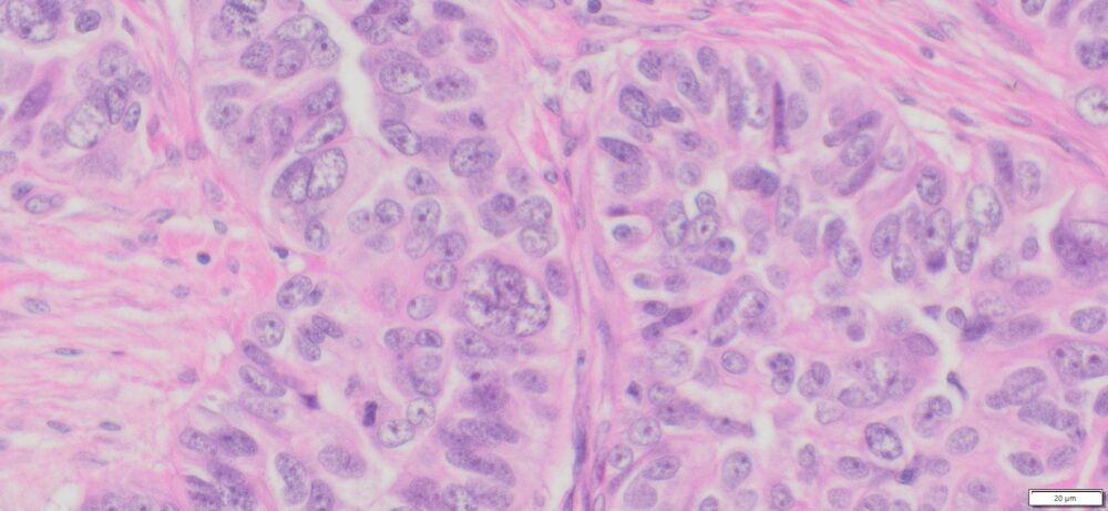 Human Ovary High Grade Serous Carcinoma (HGSC) FFPE Sections