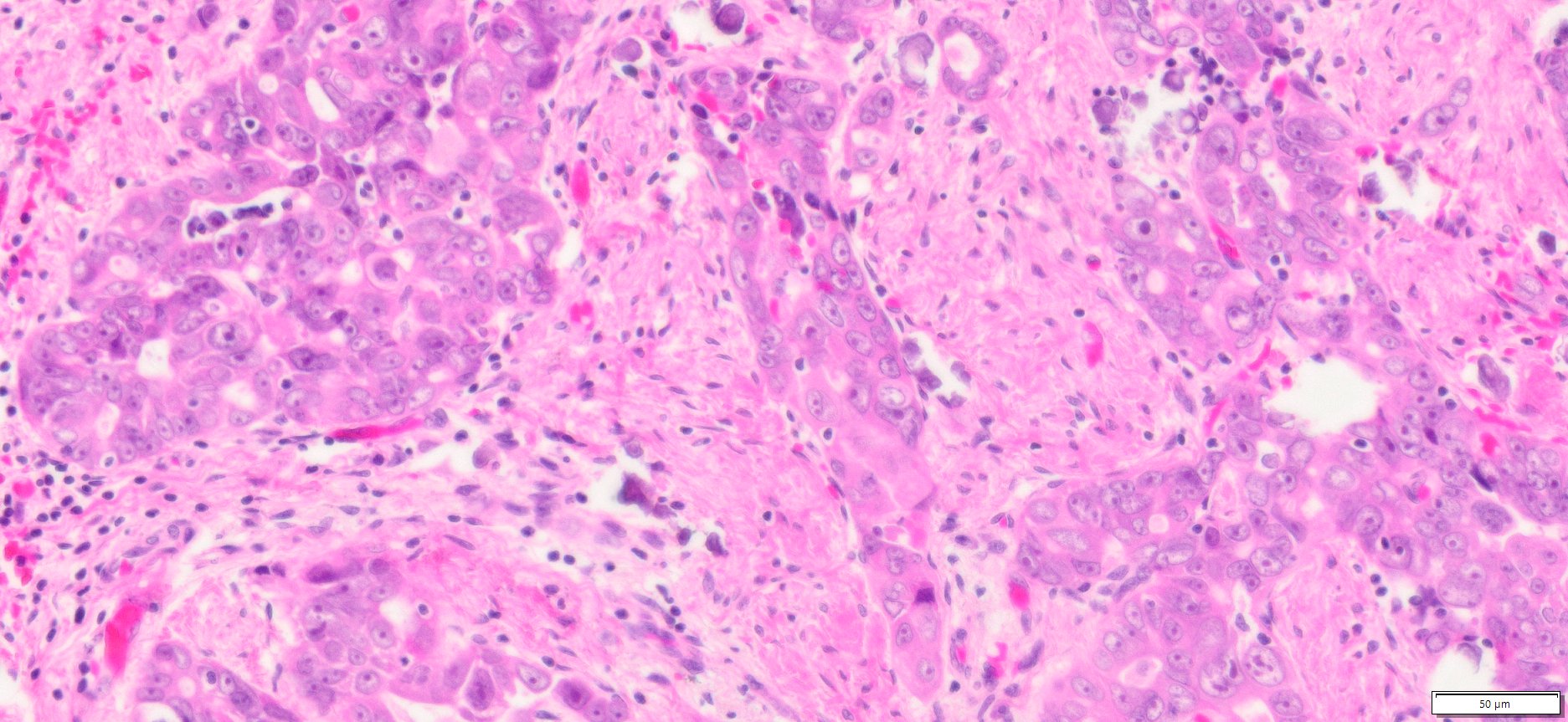 Human Ovary High Grade Serous Carcinoma (HGSC) FFPE Sections