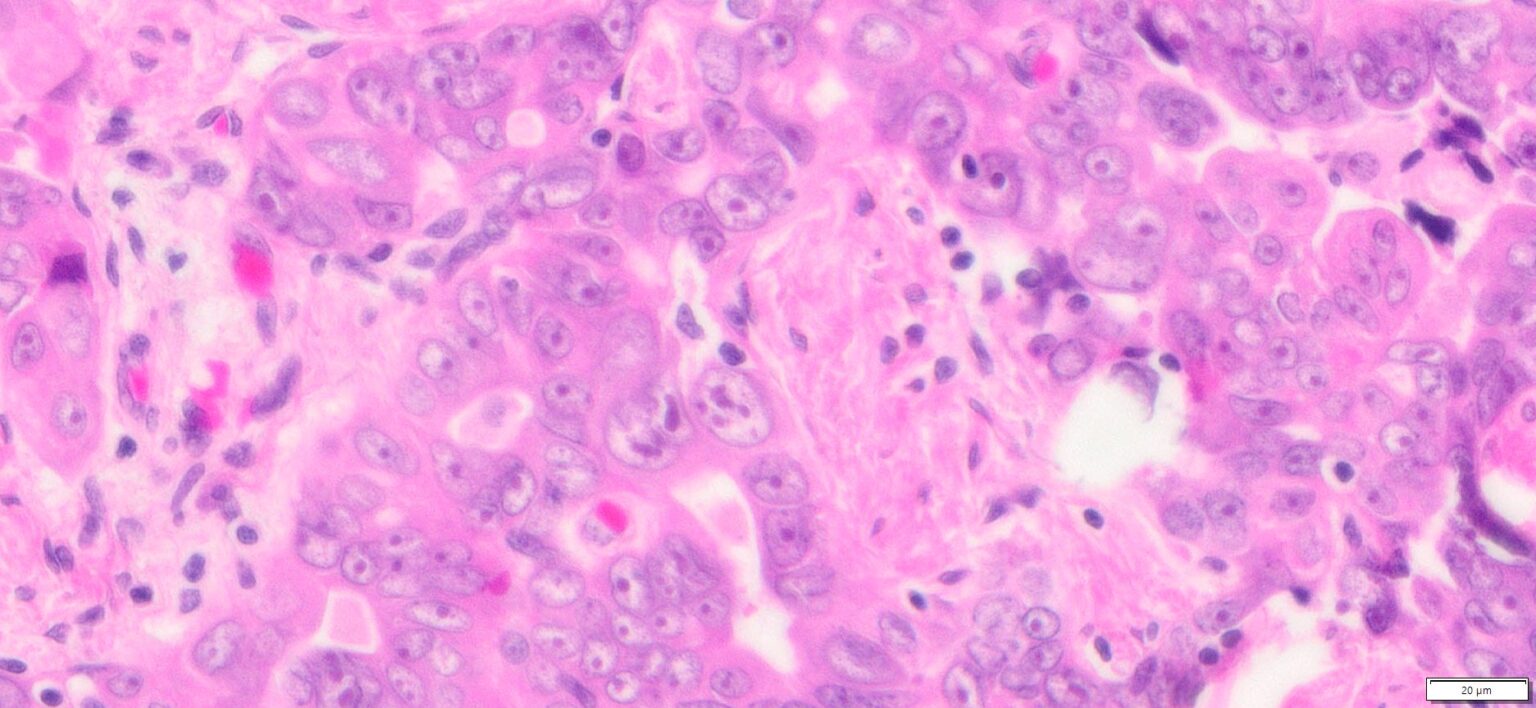 Human Ovary High Grade Serous Carcinoma (HGSC) FFPE Sections