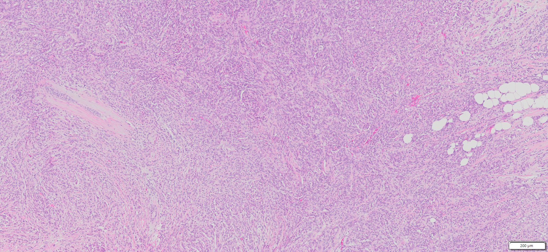 Human Breast Cancer (ER+/PR+/Her2-), (Invasive lobular carcinoma ) FFPE ...