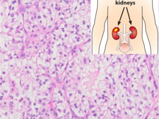 Human Kidney Cancer FFPE Sections