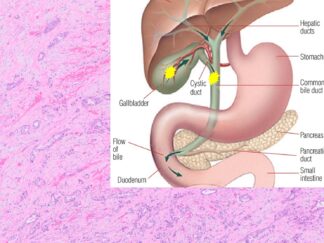 Human Gallbladder and Bile Duct Cancer FFPE Sections