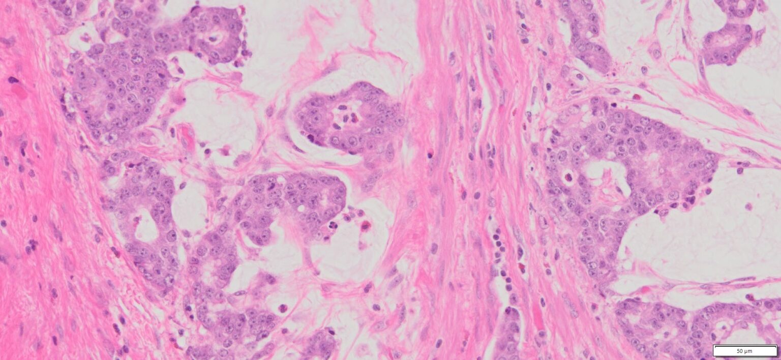 Human Appendix Mucinous Adenocarcinoma FFPE Sections