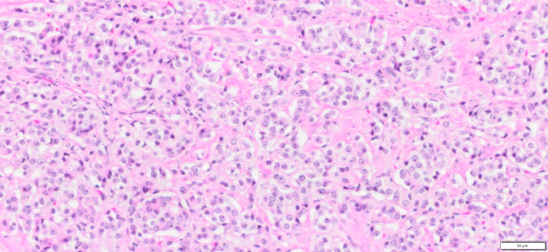 HuPS-25001T Prostate Adenocarcinoma, H&E, 20x