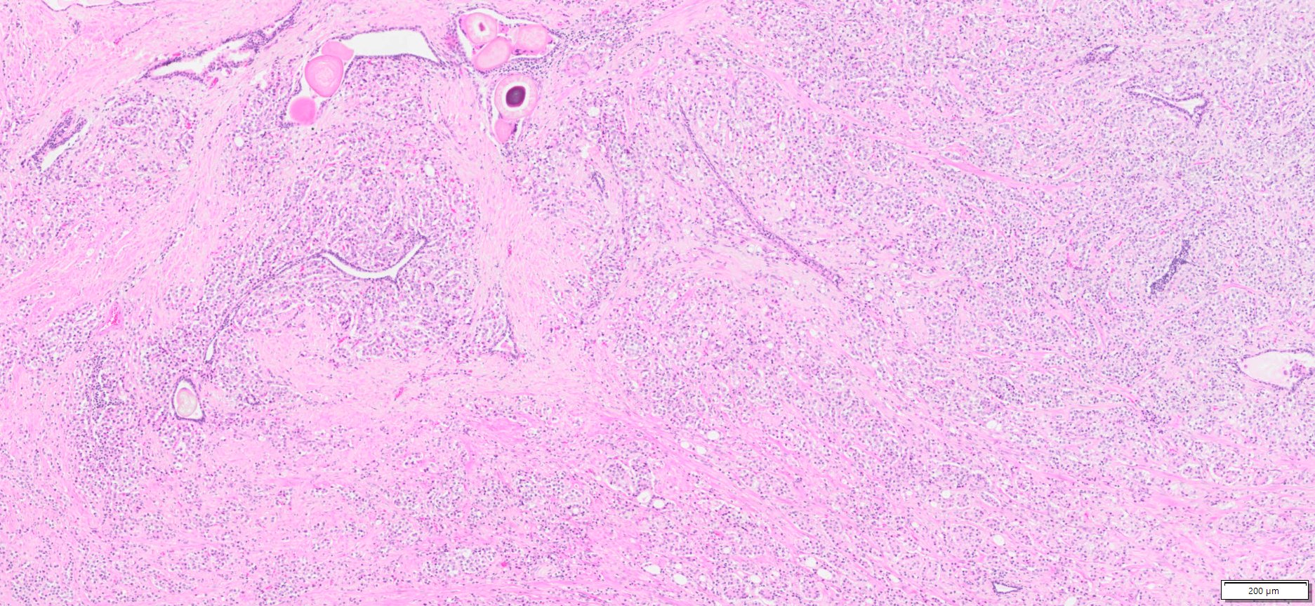 Human Prostate Adenocarcinoma FFPE Sections