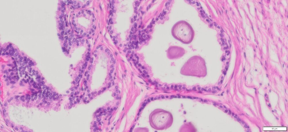 Human Prostate Adenocarcinoma FFPE Sections