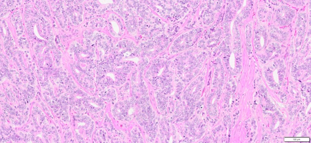 HuPS-25003T Prostate Adenocarcinoma, H&E, 10x
