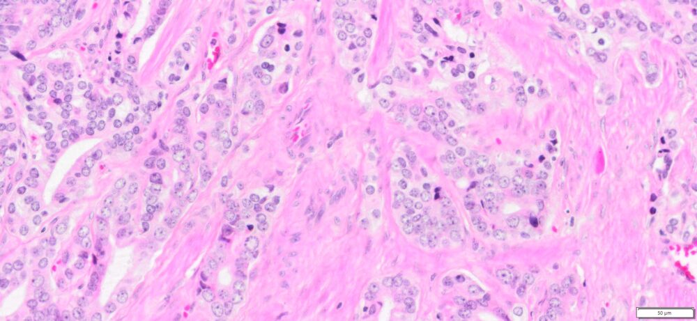 HuPS-25003T Prostate Adenocarcinoma, H&E, 20x