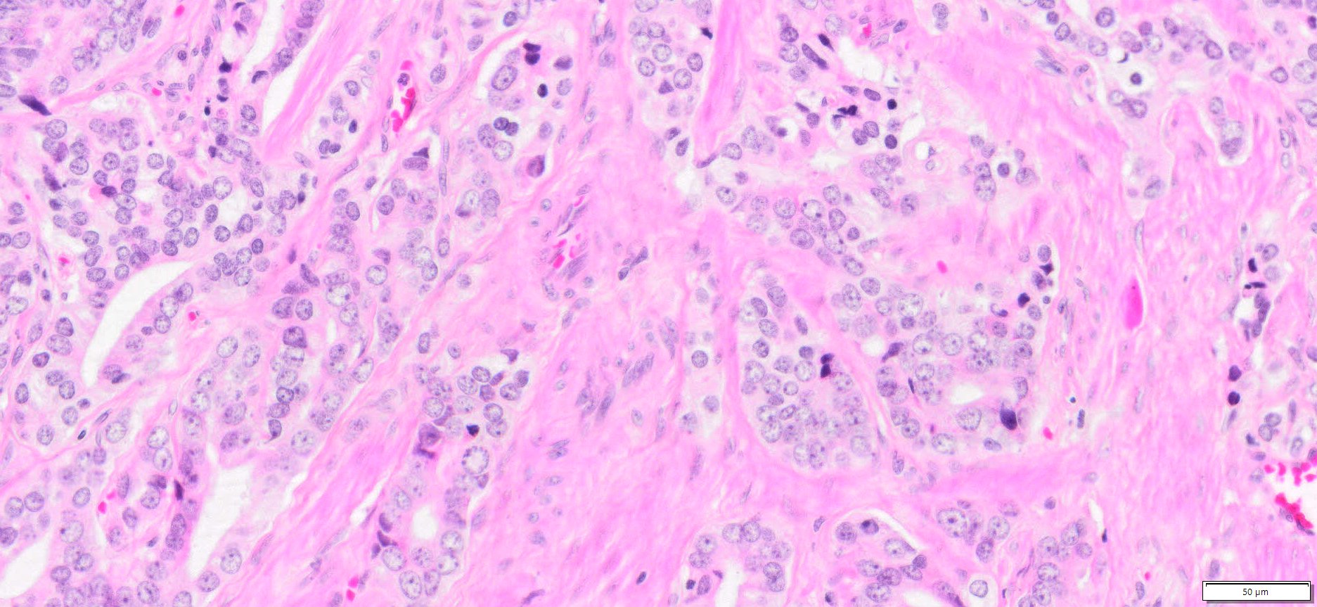 Human Prostate Adenocarcinoma FFPE Sections