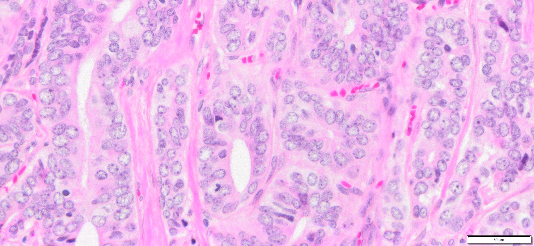 HuPS-25003T Prostate Adenocarcinoma, H&E, 40x