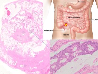 Human Appendix Cancer FFPE Sections