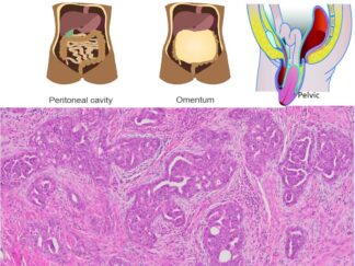 Peritoneal, Omentum and Pevic Tumor FFPE Sections