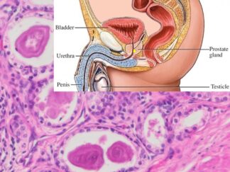 Human Prostate Cancer FFPE Sections
