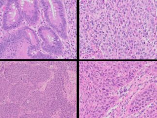 Human Tumor FFPE Sections