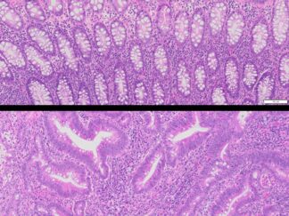 Human Tumor & Normal Matched Pair FFPE Sections