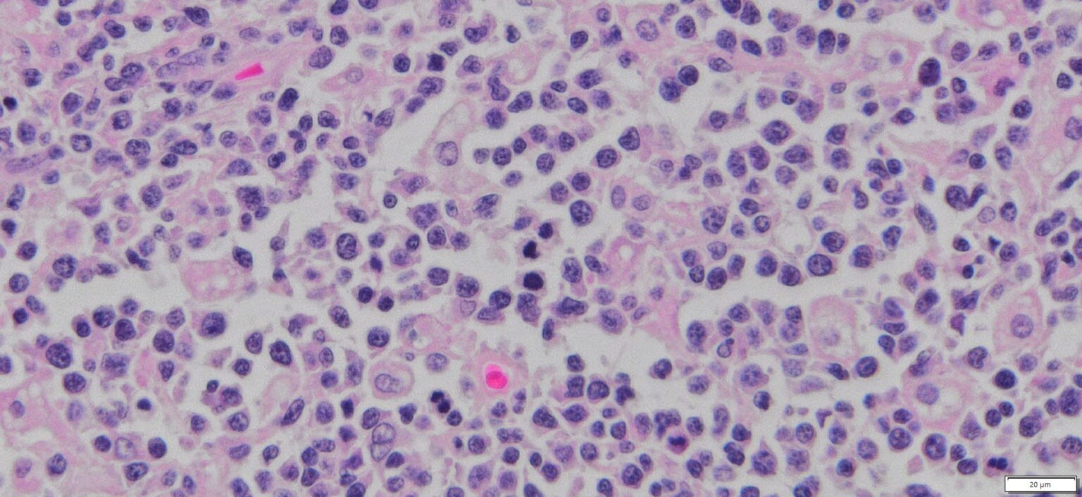 Human Diffuse Large B-Cell Lymphoma (DLBCL) FFPE Sections
